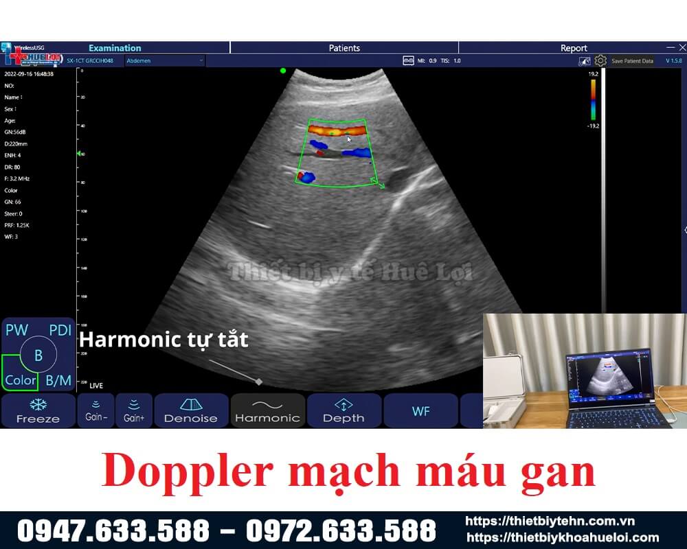 hình ảnh doppler gan của máy siêu âm 3 đầu