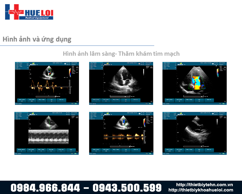 chất lượng hình ảnh siêu âm tim máy siêu âm edan u60