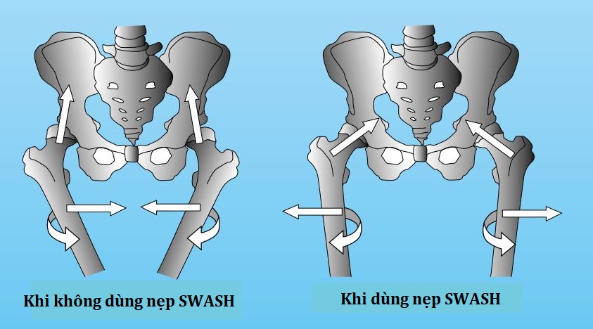 chệch khớp háng ở trẻ nhỏ